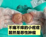 预防淋巴瘤的生活方式有哪些？
