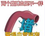 双臂血压差超标，警惕血管狭窄信号