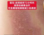不同慢性病（糖尿病 / 高血压 / 肾病）患者的高温防疱专属护理清单
