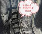 什么是脊髓型颈椎病？