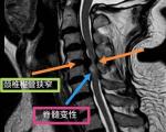 脊髓型颈椎病与其他类型颈椎病（如神经根型）的核心区别表