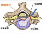 脊髓型颈椎病日常如何预防？