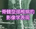 脊髓型颈椎病的治疗原则有哪些？