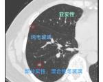 肺磨玻璃结节和实性结节的治疗方法有哪些？