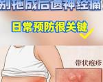 如何预防带状疱疹后遗神经痛？
