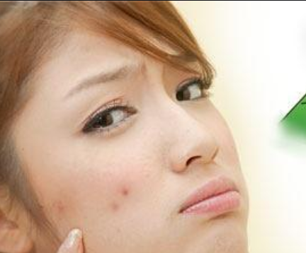 脸上为什么会长痘痘?