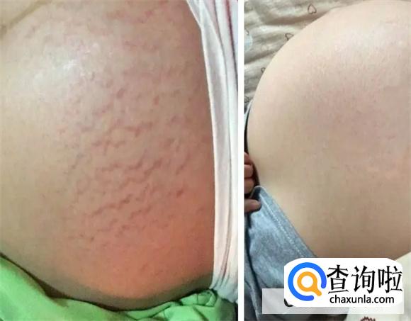 孕妇侧卧会长妊娠纹吗