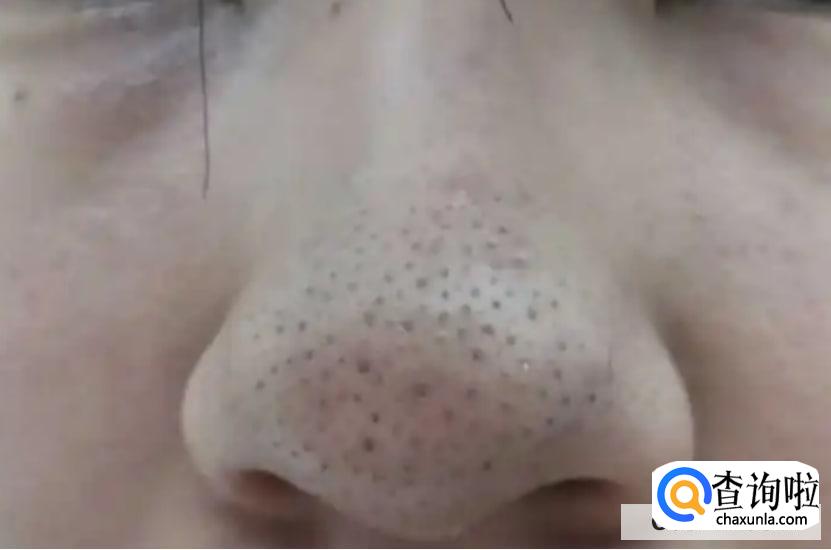 如何去鼻子上的黑头最有效方法