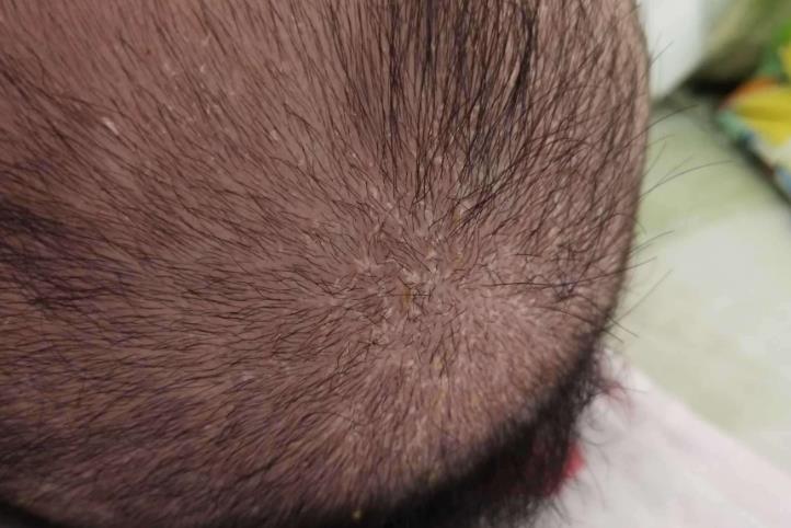 头皮很痒头皮屑很多，该如何治疗？