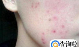 怎样快速使脸上红痘印消