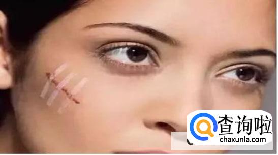 疤痕怎么去除比较好