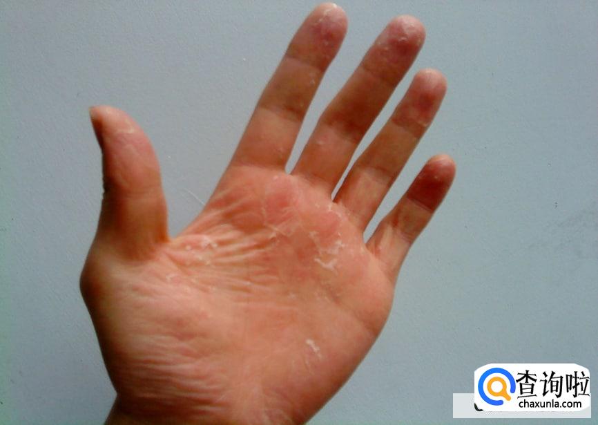 手蜕皮是怎么回事