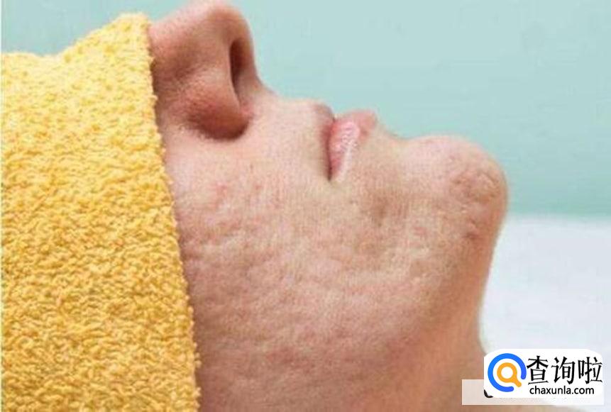 满脸痘印维生素e擦痘印有用吗