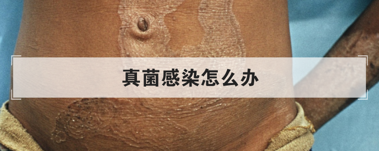 真菌感染怎么办