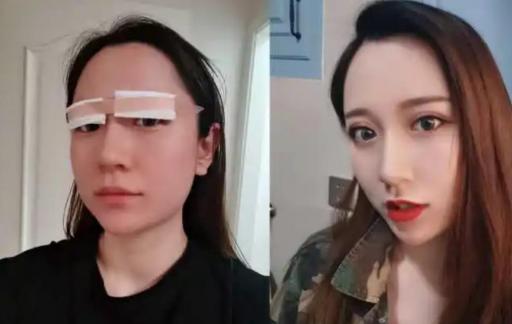 割双眼皮恢复期应该注意什么?