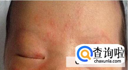 处理新生儿湿疹小妙招