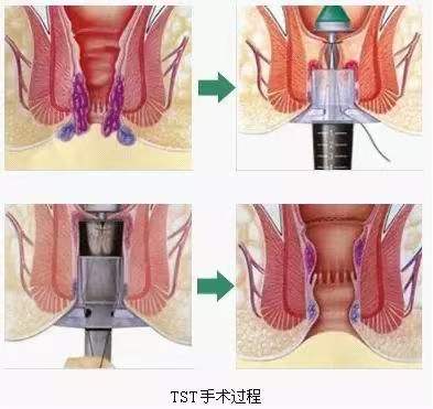 痔疮外痔肉球怎么消除用什么药