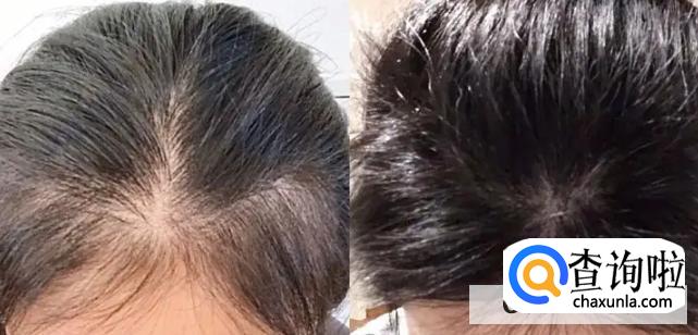 如何预防脱发