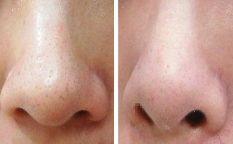 鼻子黑毛跟黑头的区别