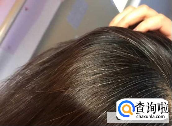 女孩为什么会长白头发