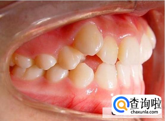 导致牙龈萎缩的原因