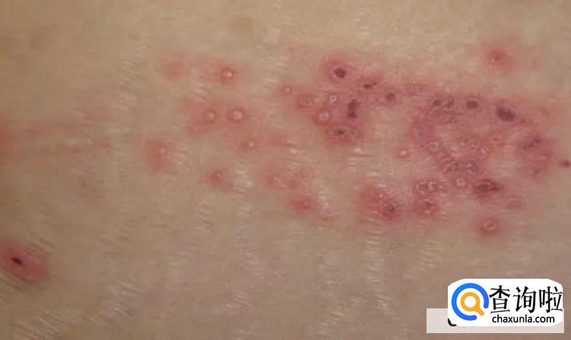 怎么诊断带状疱疹?