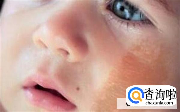 精油可以去除胎记吗