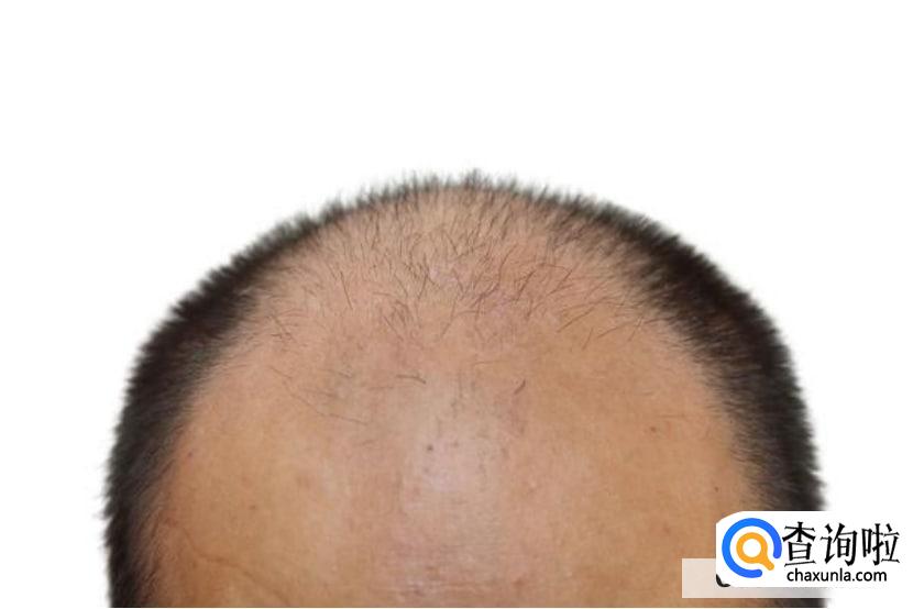 如何防止头发脱落