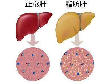 治疗脂肪肝最佳方法