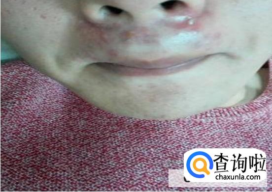 鼻翼下面长痘的原因
