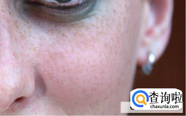 肠胃不好脸上会长斑吗