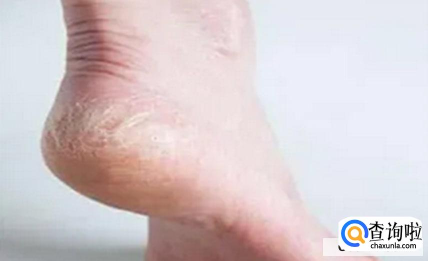 脚后跟干裂如何保养及护理