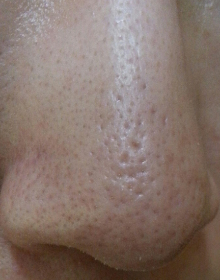 鼻子黑毛跟黑头的区别