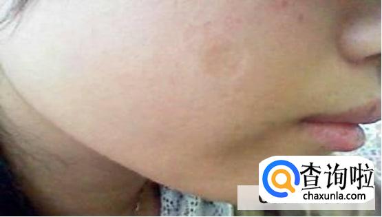 疤痕怎么去除比较好