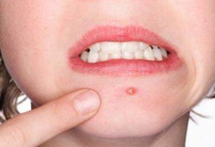 脸上为什么会长痘痘?